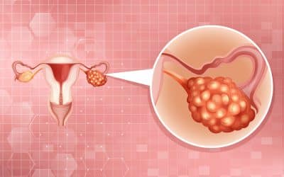 Targeting homologous recombination deficiency in ovarian cancer