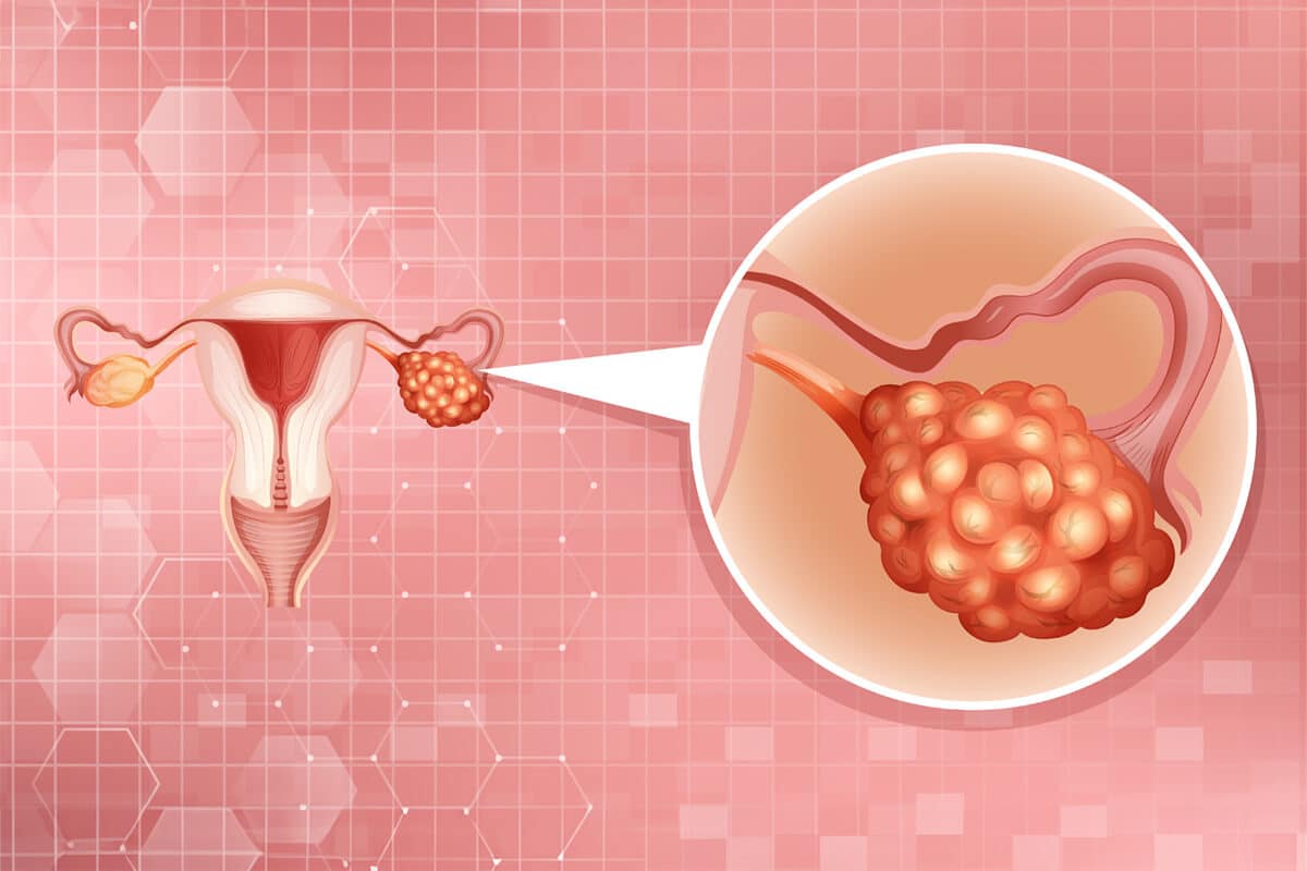 Clinomics Europe - Targeting homologous recombination deficiency in ovarian cancer