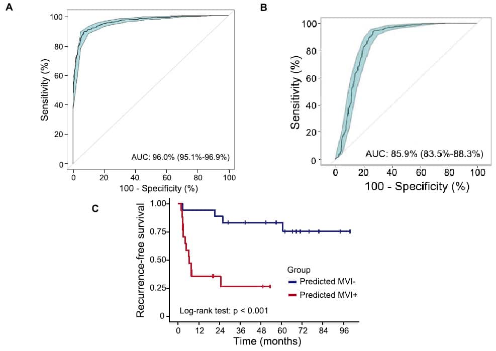 The classification model can separate normal and HCC plasma samples sensitively and specifically using the 65 MHB markers; B: MVI markers accurately classified MVI- and MVI + tissues; C: Chances for recurrence-free survival is significantly larger by the MVI- group than the MVI+ group.